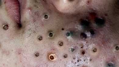 Photo of Video Relax with Squeeze Acne #22