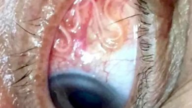 Photo of Search Results for: The Essentials of Eye Health: How to Prevent Infections